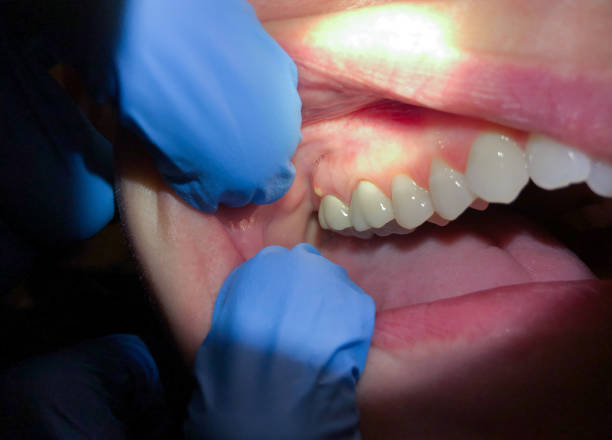 Best Tooth Infection Emergency Dentist  in Mount Kisco, NY